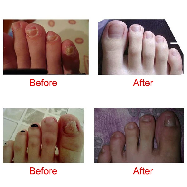 

Foot Nail Toe Remove Fungus Liquid Essence Repair Moisturizing Cleaning Care Treatment M88