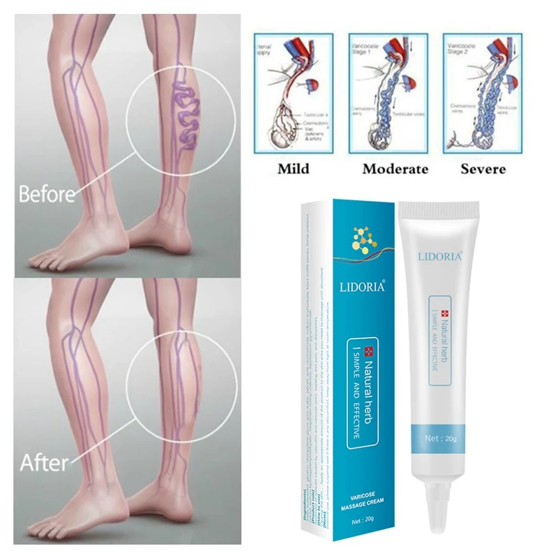 Varicose Veins Cream Promote Blood Circulation Relief Phlebitis Vasculitis Treatment Ointment Vessel Care |