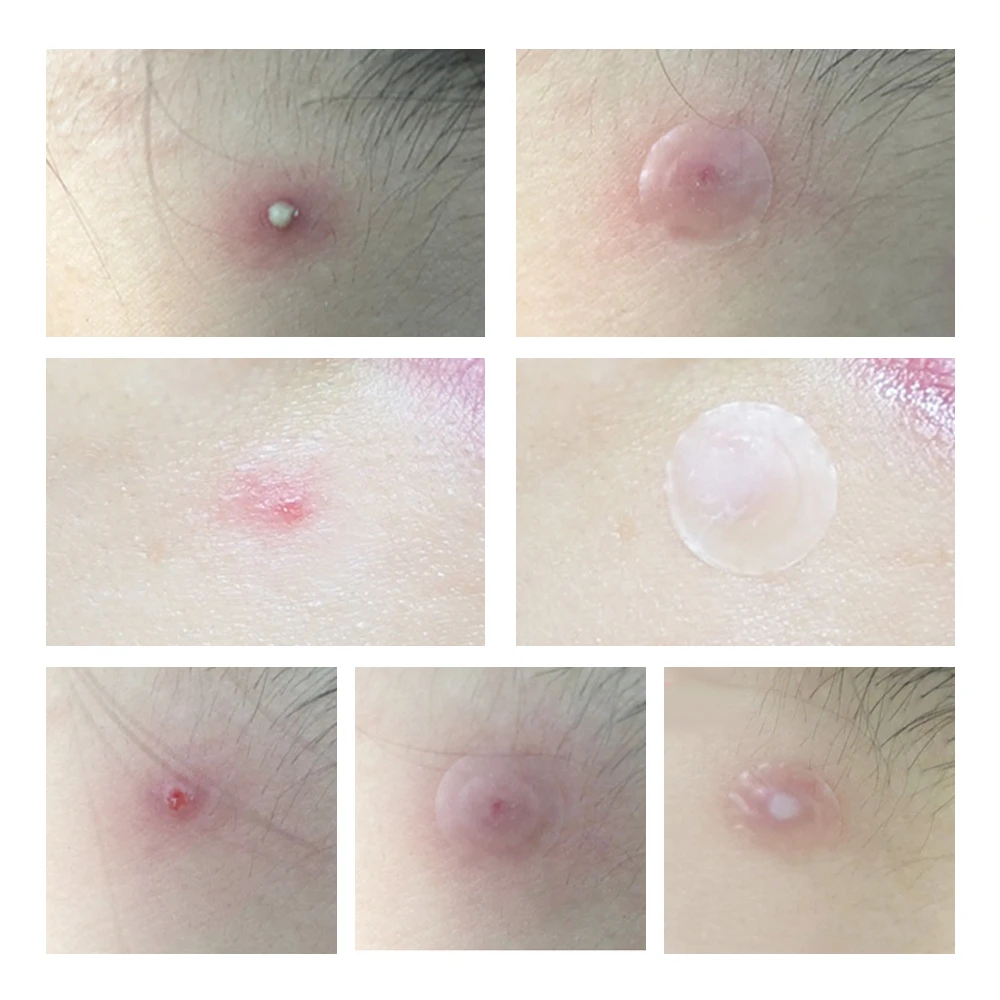 LANBENA акне прыщи патч ежедневное использование маска для лица невидимые наклейки