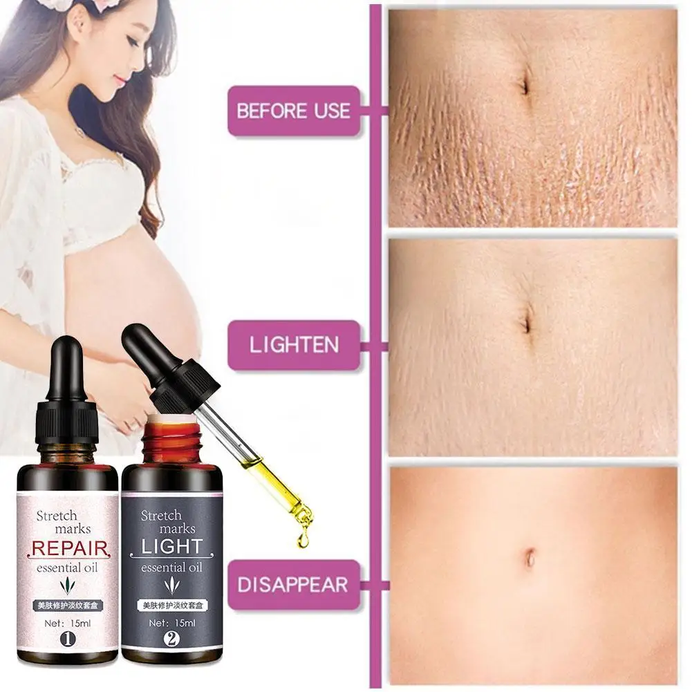 

Stretch mark remover essential oil skin care treatment cream slackline oils removal For pregnant For maternity mark stretch X6Q7