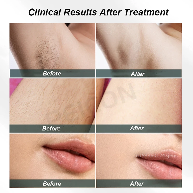 

IPL Laser Hair Removal For Women Bikini Face Body Epilator Machine Professional Mini Painless Permanent Hair Remover Devices