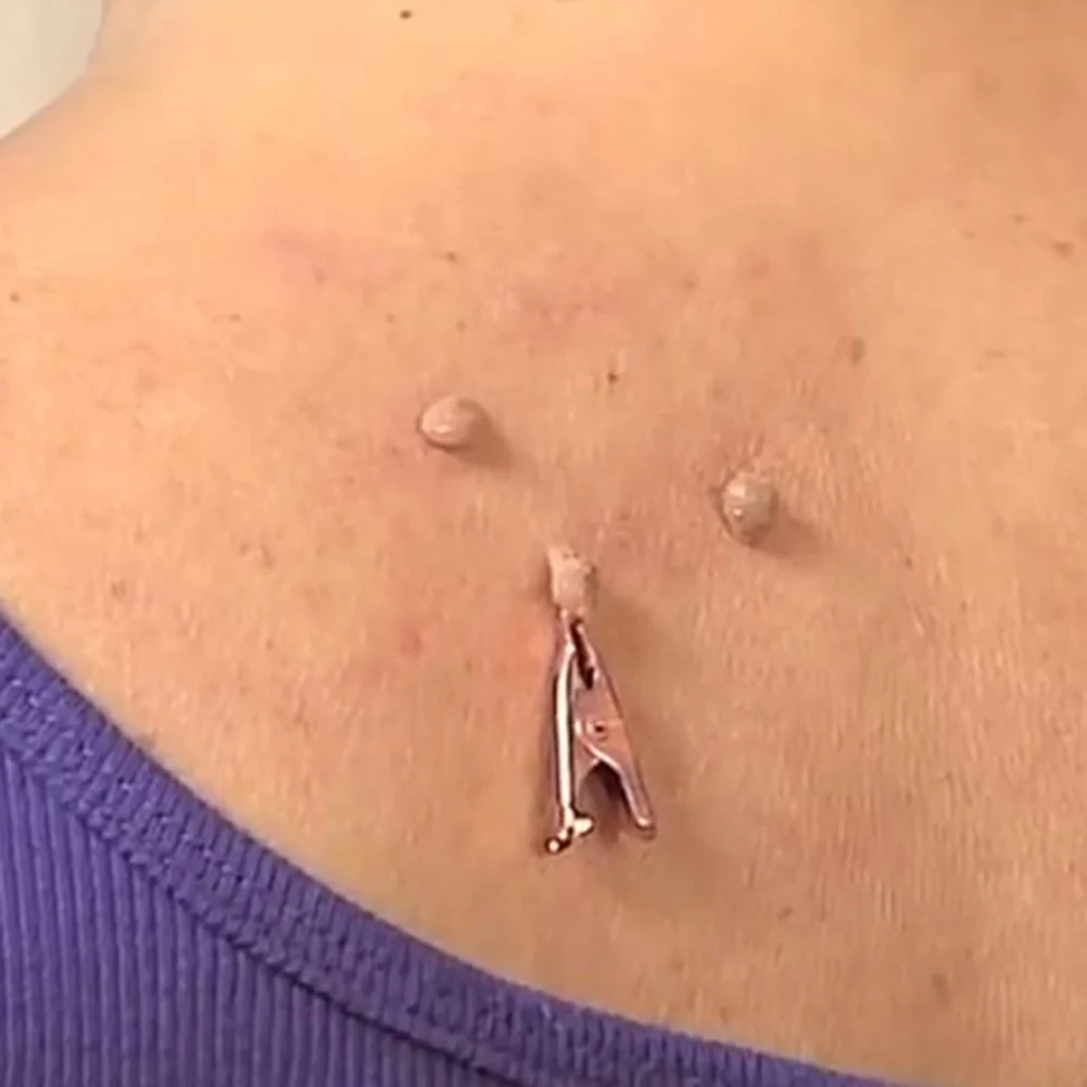 

2021 Wart Remover Pointed Mouth Clips Face Acne Pimple Accessories Copper Tag Blemish Removers Coppers Skin Wart Tag