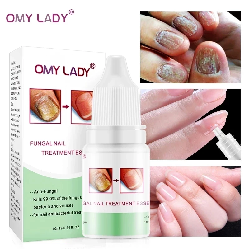 

OMY LADY High Quality 10ML Nail Protector Skin Care ESSENCE Cream Nail Fungus Treatment Nails Repairing Cream Nail Care Tools