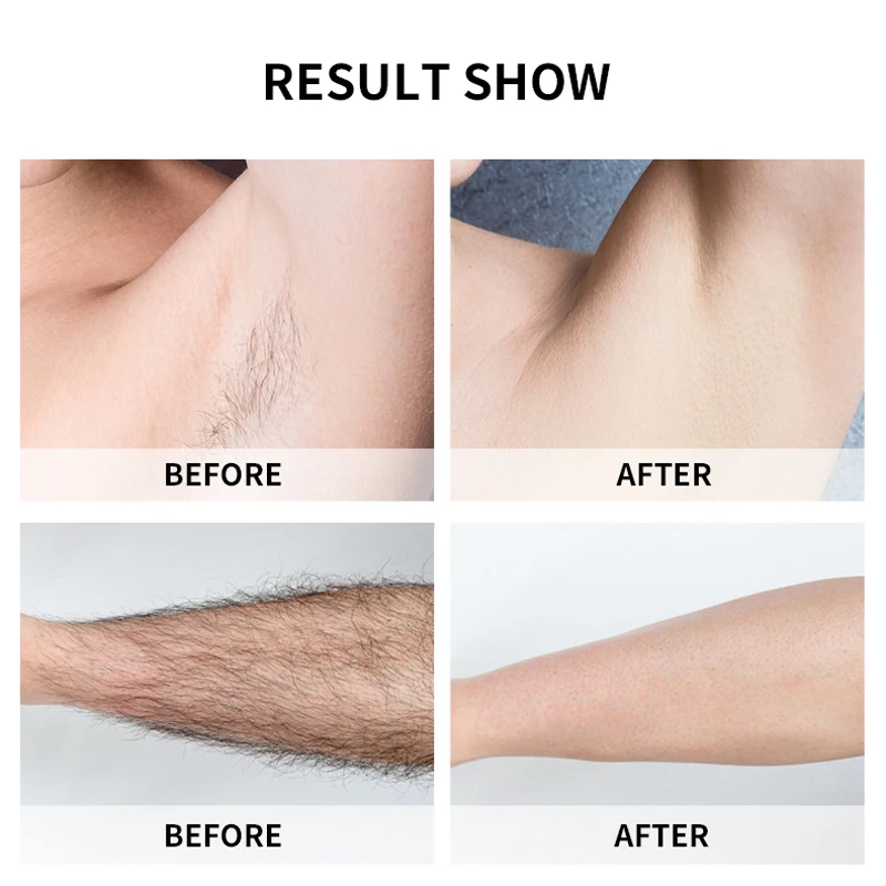 

Kyliebeauty Epilator 900000 Flash IPL Hair Removal Laser Permanent Epilator For Women Painless Photoepilator Depiladora Facial