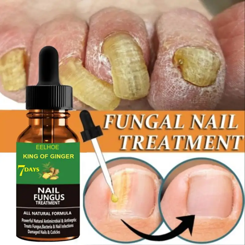 

Eelhoe 30/50ml Ginger Foot Antifungal Essence Remove Onychomycosis Repair Nail Treatment Liquid Healthy Nail Care Nail Art TSLM2