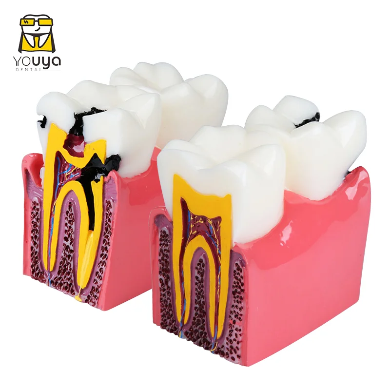 6 раз Стоматологическая модель молярной патологической анатомической