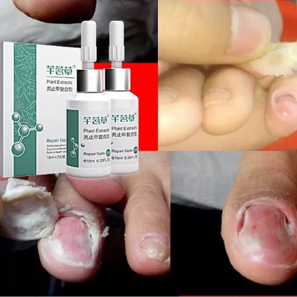 10 мл * 2 убивает бактерии уход за ногтями Лечение грибка масло онихомикоз