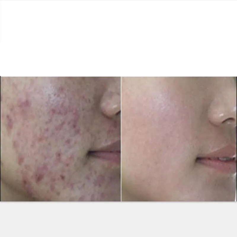 

60pcs /180pcs Purim natural herbal detox, anti-acne, rosacea, pigmentation , relief skin allergies 60pcs/bottle