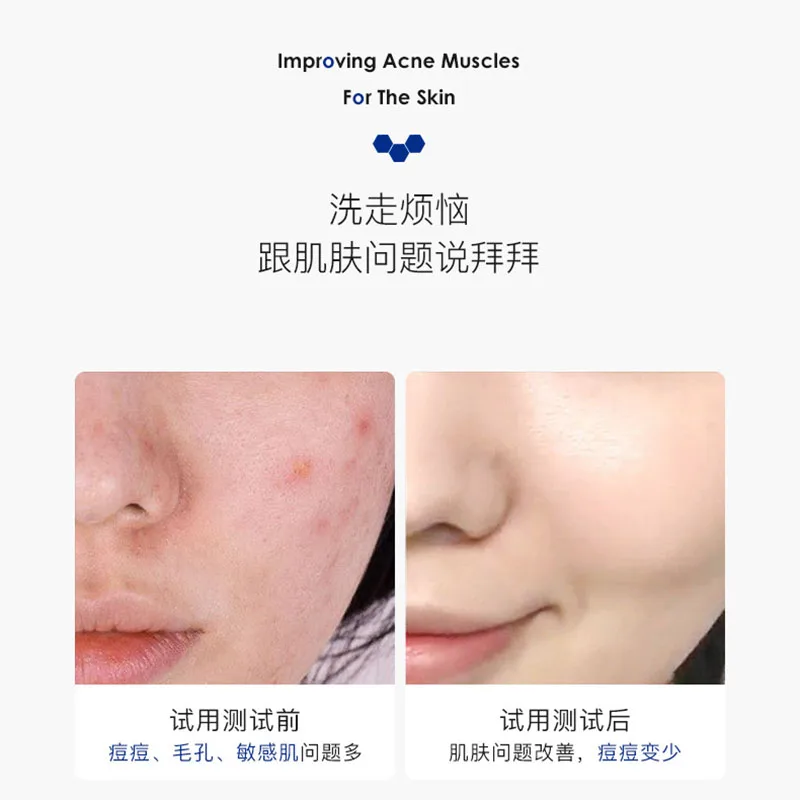 Очищающее средство для лица удаления черной головы глубокого очищения кожи от