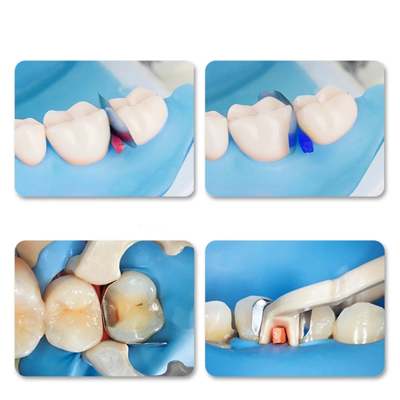 Комплект стоматологической секционной матричной системы зажимные кольца и