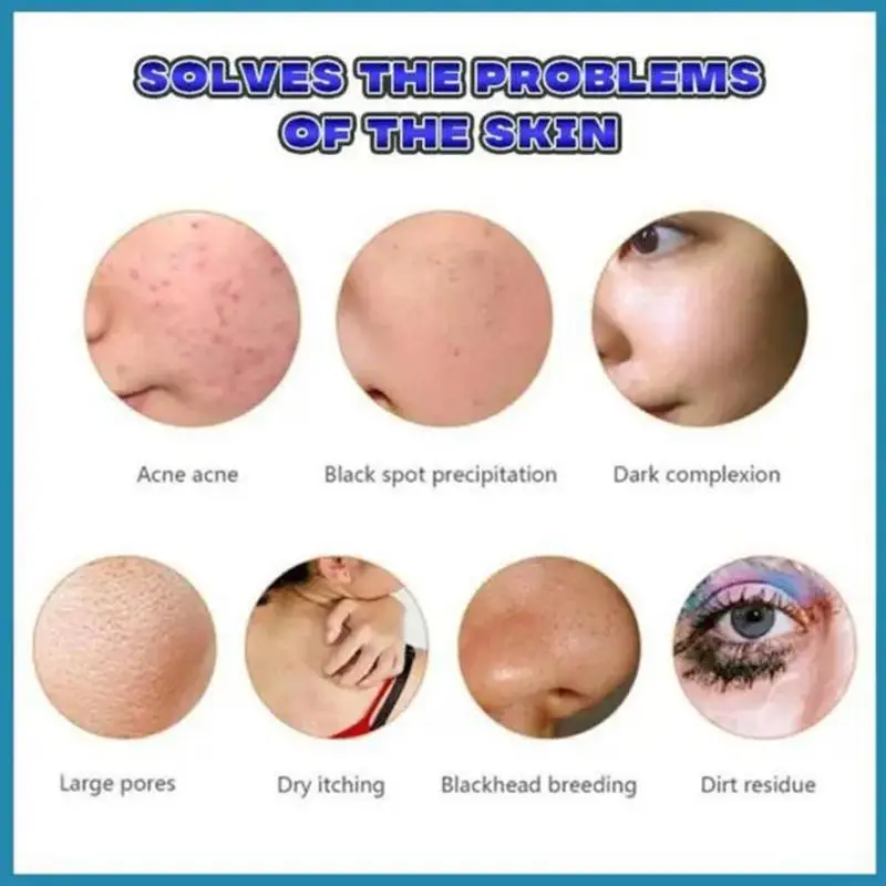 Natural Herbal Topical Cream Face Pimples Scar Stretch Marks Removal Acne Cream Whiten Face Skin Care Treatment