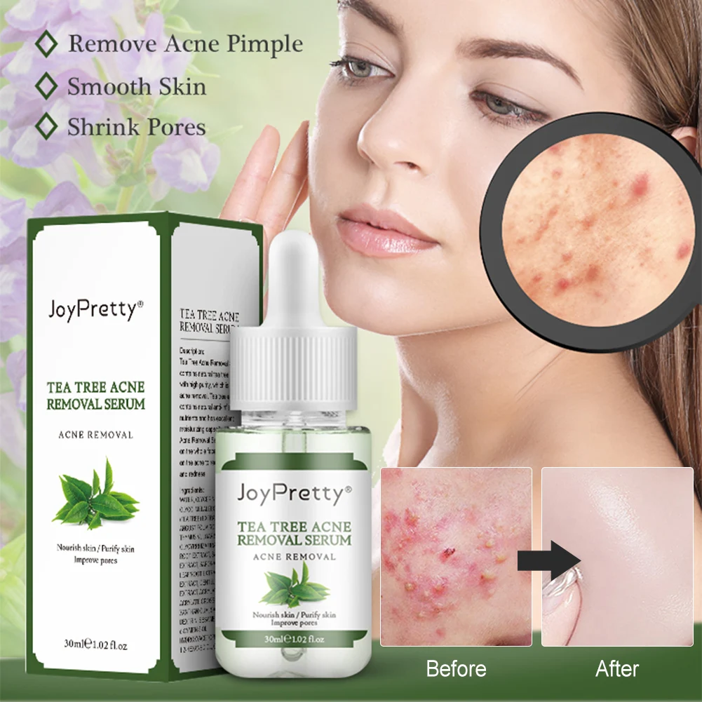 

Tea Tree Skin Serum Acne Removal Serum Natural Safe Face Serum for Fading Acne Marks Spots Skin Care Serum for All Skins