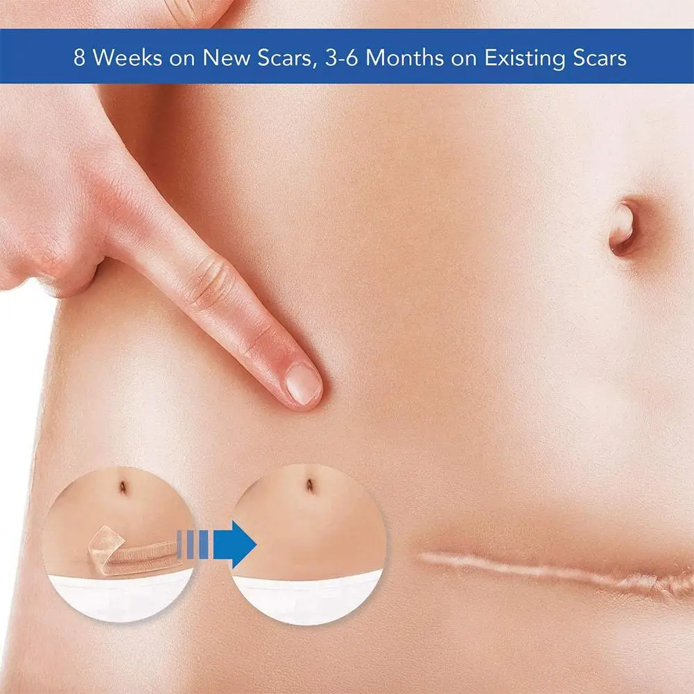 

Self-adhesive Stretch Marks Scalds Caesarean Section Surgery Removal Cosmetic Scar Patch V6R4