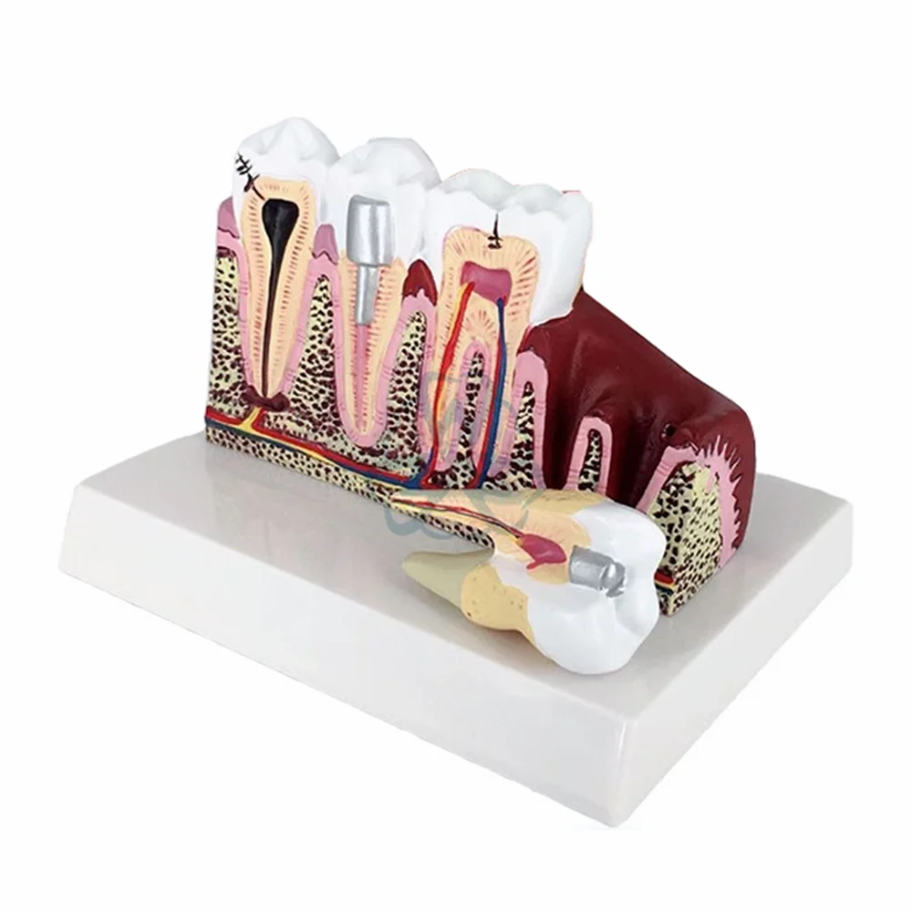

1pcs Detachable Dental Anatomy of dental caries plastic teeth model demonstration communication