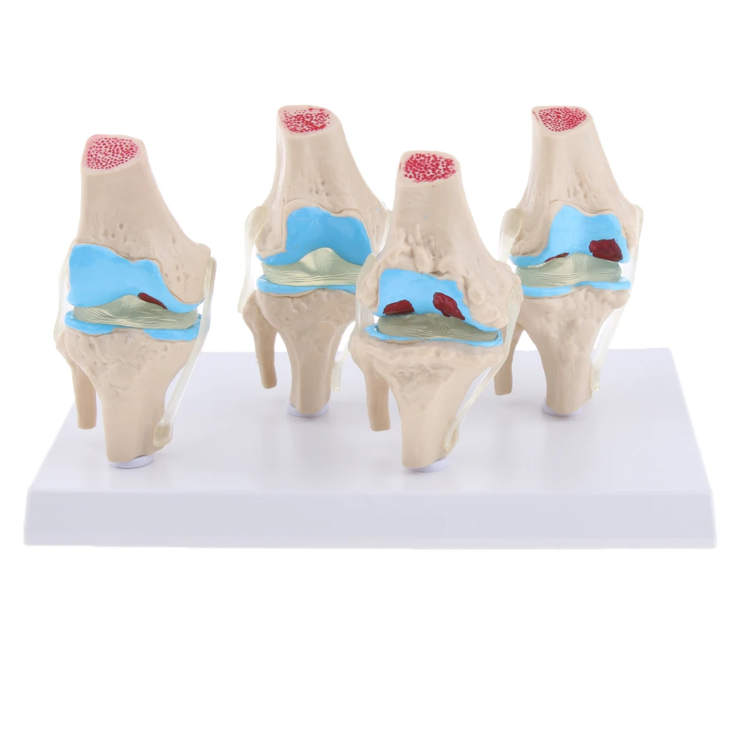 

Lifesize 4-Stage Anatomical Human Morbid State Degenerative Knee Joint Model