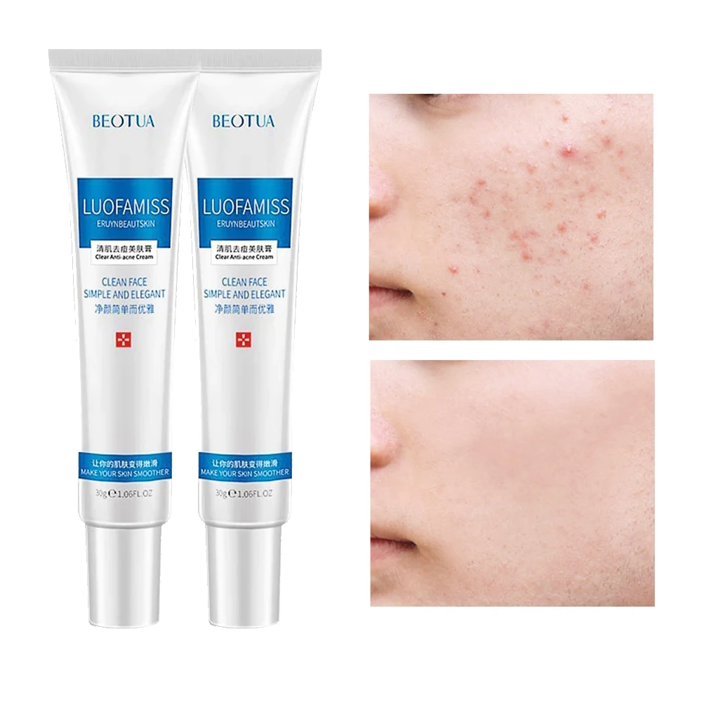 

2 шт., отбеливающий увлажняющий крем для удаления акне