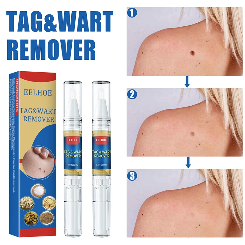 

3ml Removing Against Moles Genital Wart Treatment From Skin Tags Remover Anti Wrat Remedie skin beauty