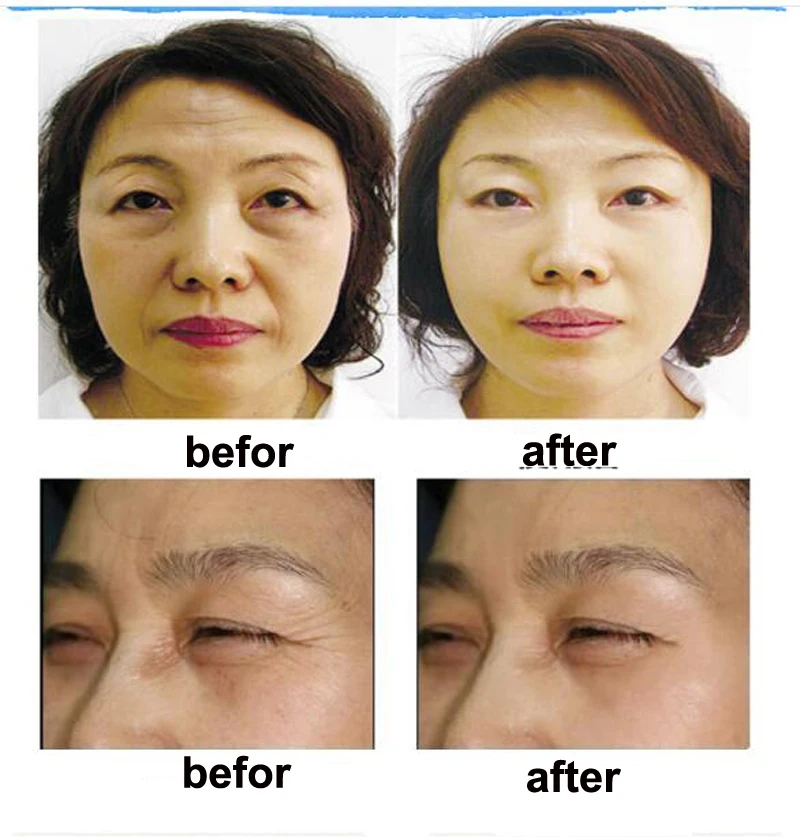 Peptide Lyophilized Powder Serum Acne Wrinkle Pimples Treatment Epidermal Growth Factor Hydrating Moisturizing Skin Care | Красота и
