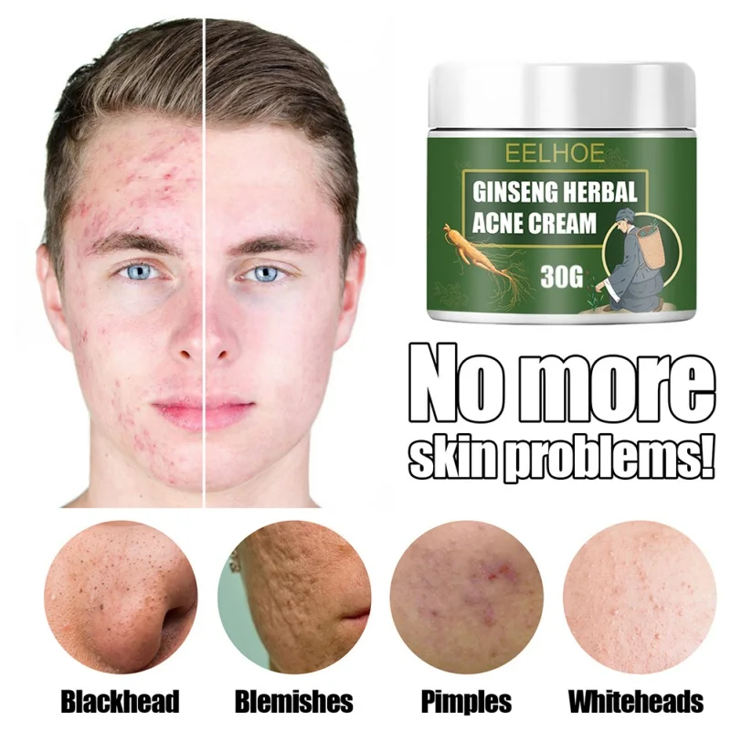 Herbal Ginseng Acne Cream Relieve Moisturizing Skin Care Blackhead Removal Facial | Красота и здоровье