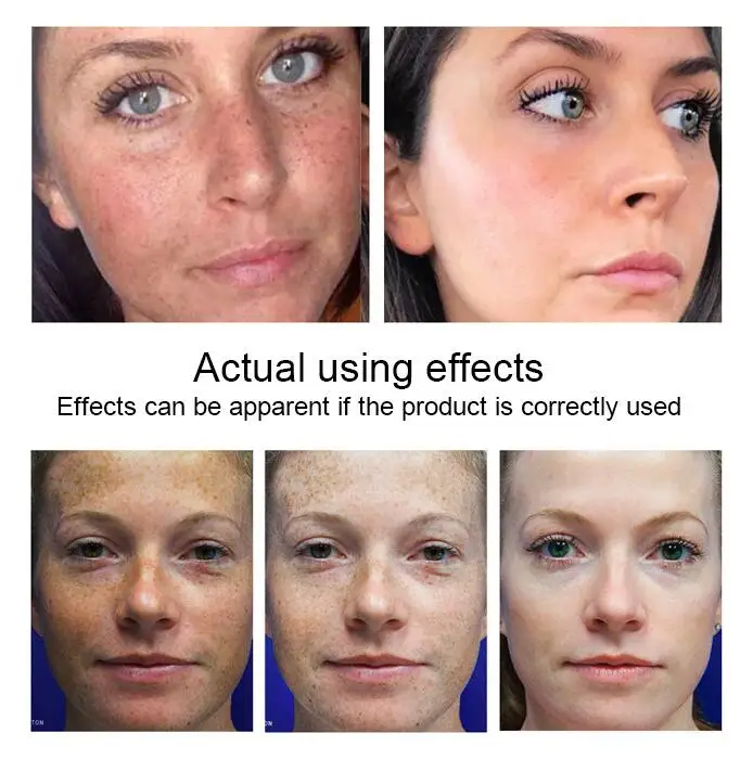 

High-efficiency Freckle Whitening Cream Dark Spots Removal Skin Whitening Deep Moisturizing Skin Lightening Cream Skin Care