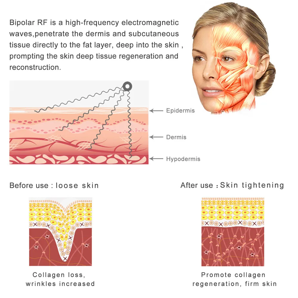 Радиочастотный массажер для лица лифтинг высокая частота биполярное удаление