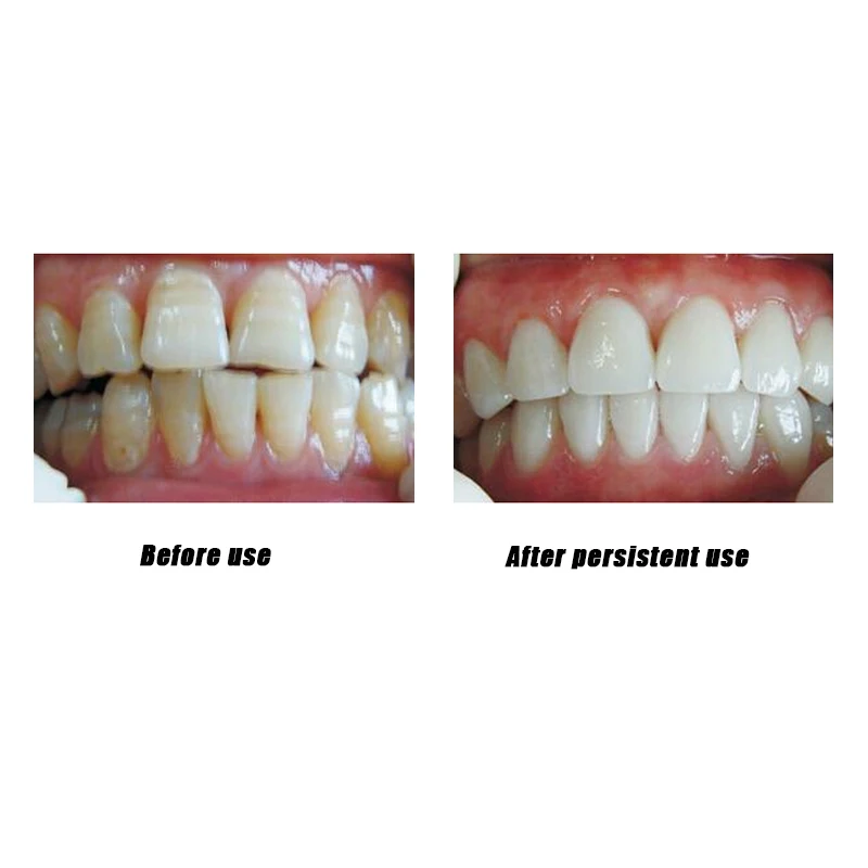 Зуб расчеты жидкость для снятия Электрический Sonic зубная щётка от зубных пятен