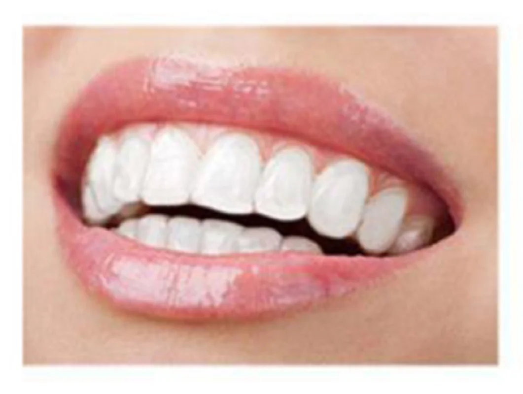 Отбеливание зубных протезов накладные зубы виниры отбеливание удобные