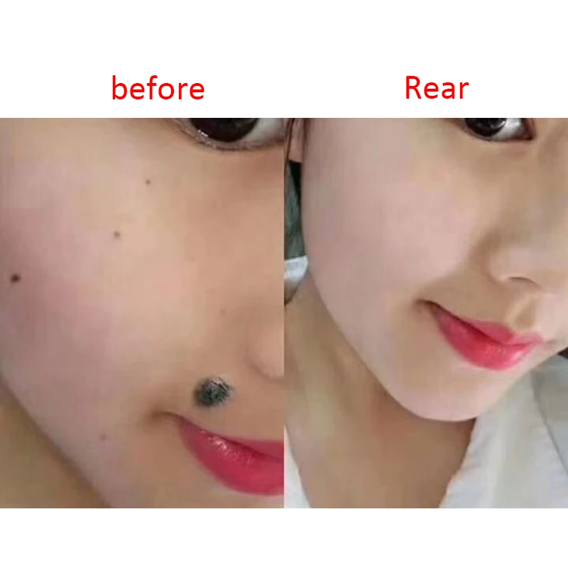 Professional Mole Removal Cream Facial Freckle Wart Tag Face Care Repair Solution Painless TSLM2 |