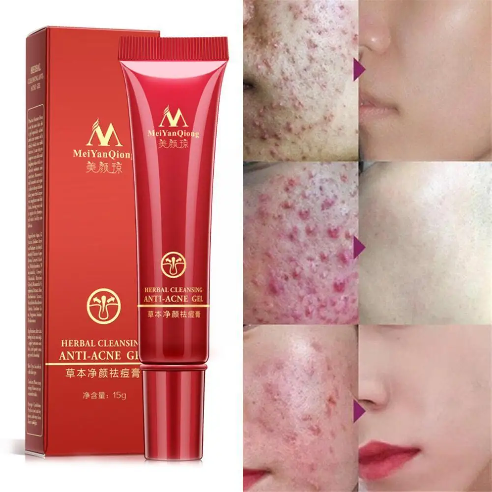 Крем для лица против акне уход за кожей удаление и восстановление комедонов