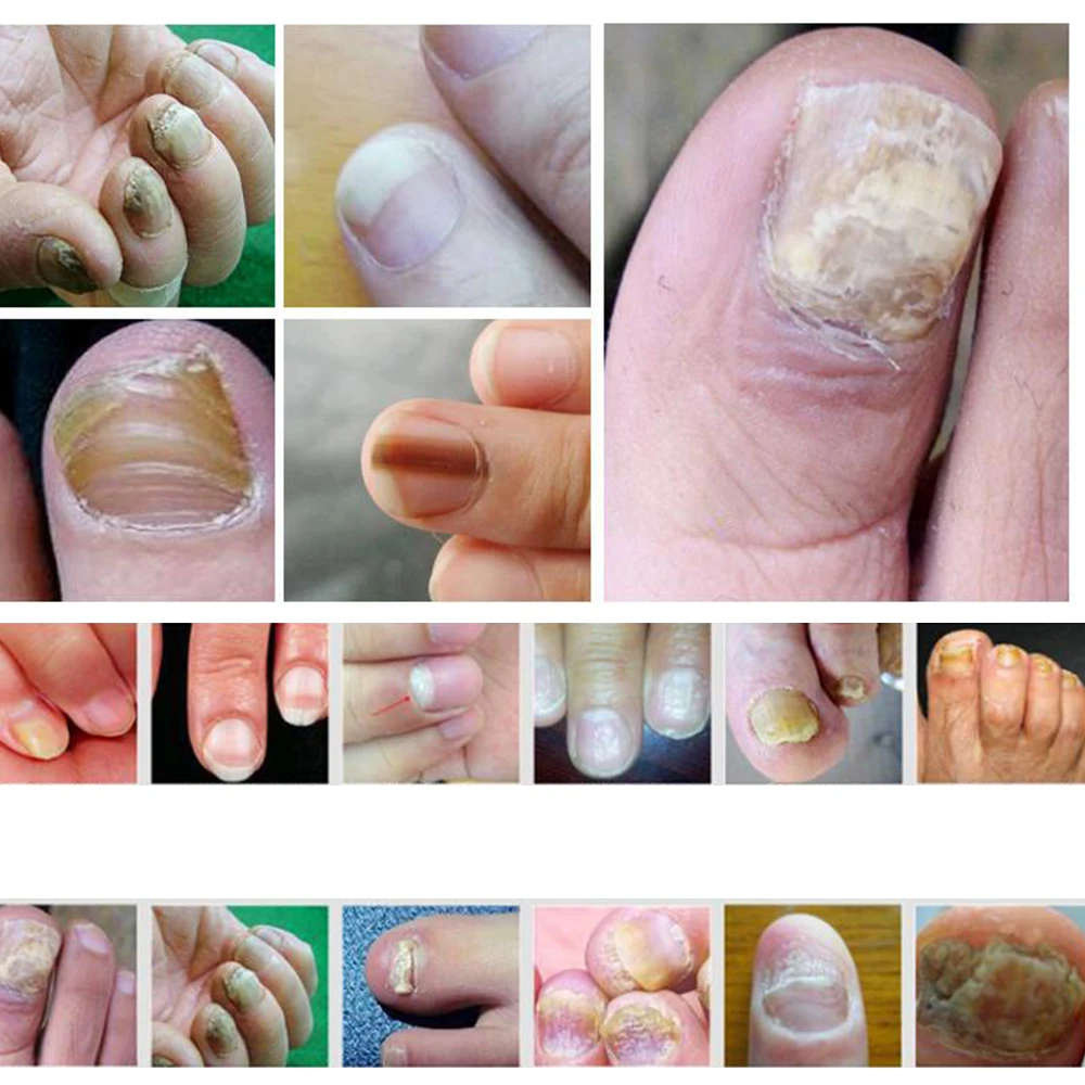 Убивает 99.9% бактерий масло от грибка ногтей онихомикоз паронихия