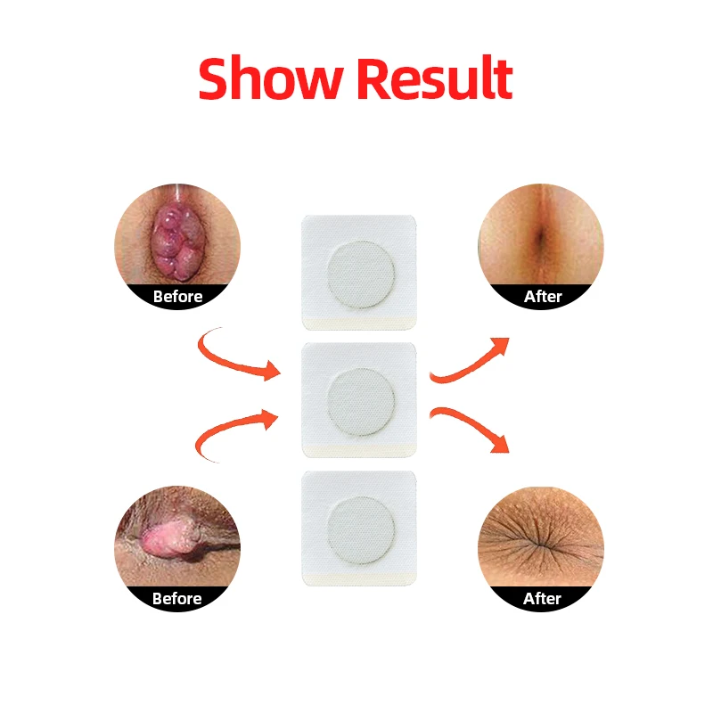Chinese Hemorrhoids Ointment Patch Sterilize For Internal Piles External Anal Cream | Красота и здоровье