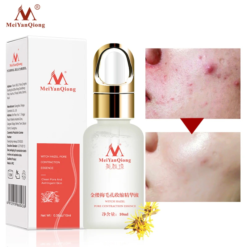 

Acne Treatment Face Serum Shrink Pores Essence Remove Acne Scars Marks Oil Control Anti-Acne Whitening Moisturizer Skin Care