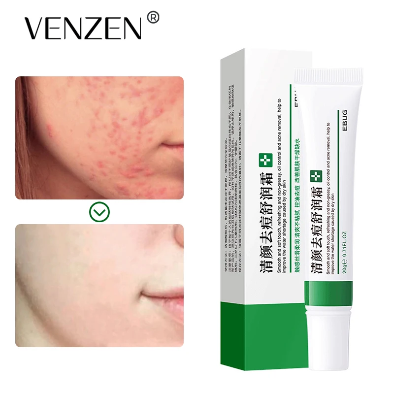 

YILUYING Removal Cream Effective Acne Treatment Fade Acne Spots Oil Control Shrink Pores Whitening Moisturizing Skin Care 20G