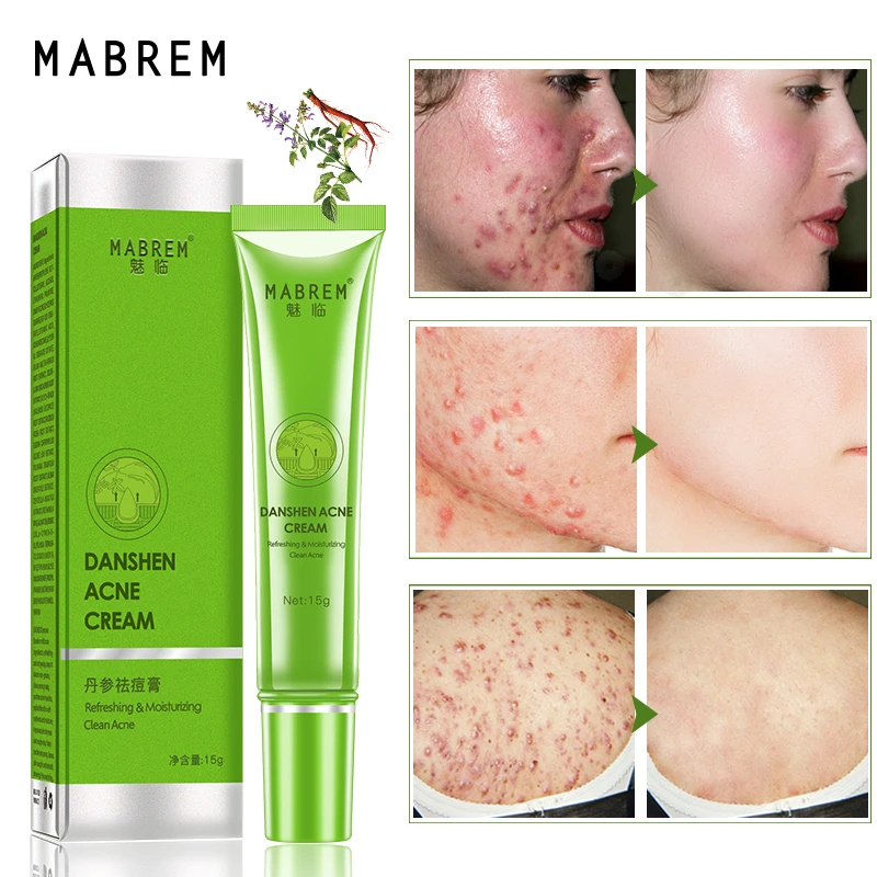

MABREM Acne Treatment Remove Acne Oil Control Oil Shrink Pores Whitening and Moisturizing Scar Removal Facial cream Skin Care