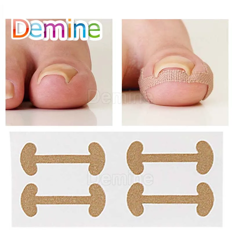 Новые инструменты для ухода за ногами коррекция ногтей Педикюр фиксатор строки