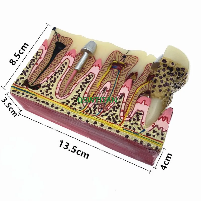 Стоматологическая модель зубов кариеса обычная патологий обучающая для