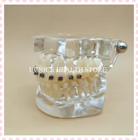 standard 28 teeth model m3003transparent tooth model with bracketsoral teaching model