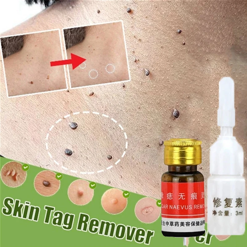 

Skin Tag Remover Solution Painless No Trace Mole Skin Dark Spot Removal Face Wart Tag Freckle Removal Cream Oil Plaster