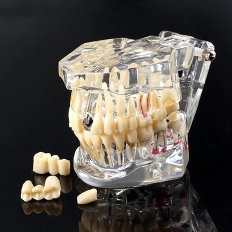 

Dental Pathology Tooth Model Teaching Medical Teeth Dentistry Implant Restoration Bridge