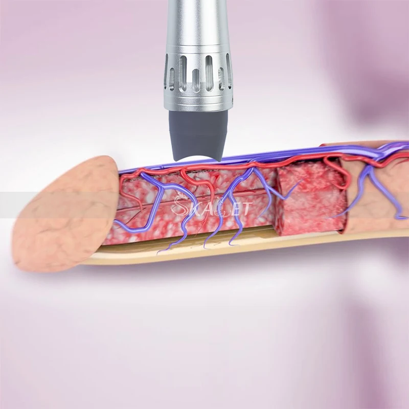 Эффективная физиотерапия система акустическая Ударная Волна