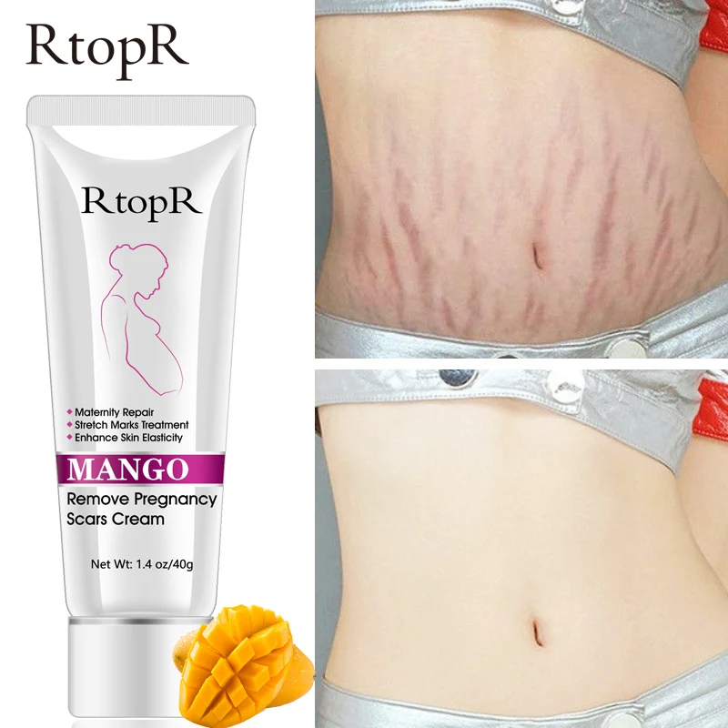 

Mango Remove Pregnancy Scars Acne Cream Stretch Marks Treatment Maternity Repair Anti-Aging Anti-Winkles Firming Body Creams 40g