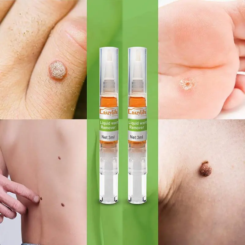 

2 pcs Skin Wart Remover Pen Skin Tag Mole Genital Wart Remover Foot Corn Verruca Wart Remover Liquid wart liquid pen skin care