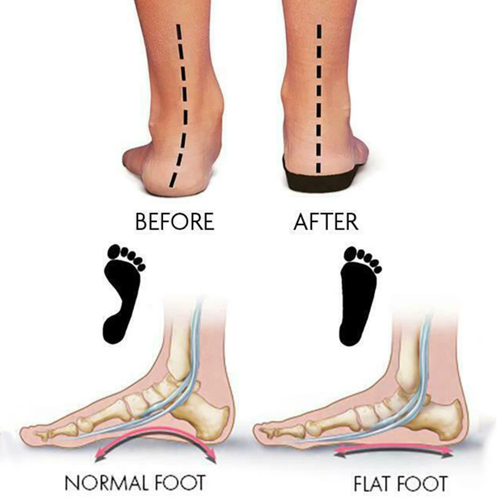 Unisex Feet Orthopedic Bunion Corrector Overlapping Toes Separator Protector Toe Flexible Finger Spacer Manicure | Красота и здоровье