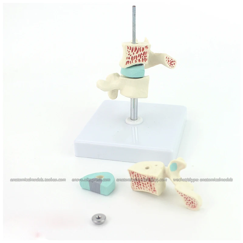 

12391-1/Osteoporosis, Backbone Anatomical Human Model/CMAM