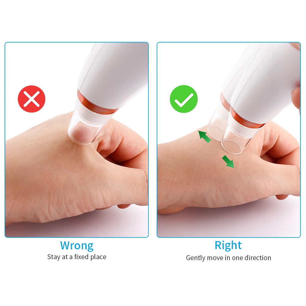 Электрический прибор для удаления черных точек с черными точками пор и акне