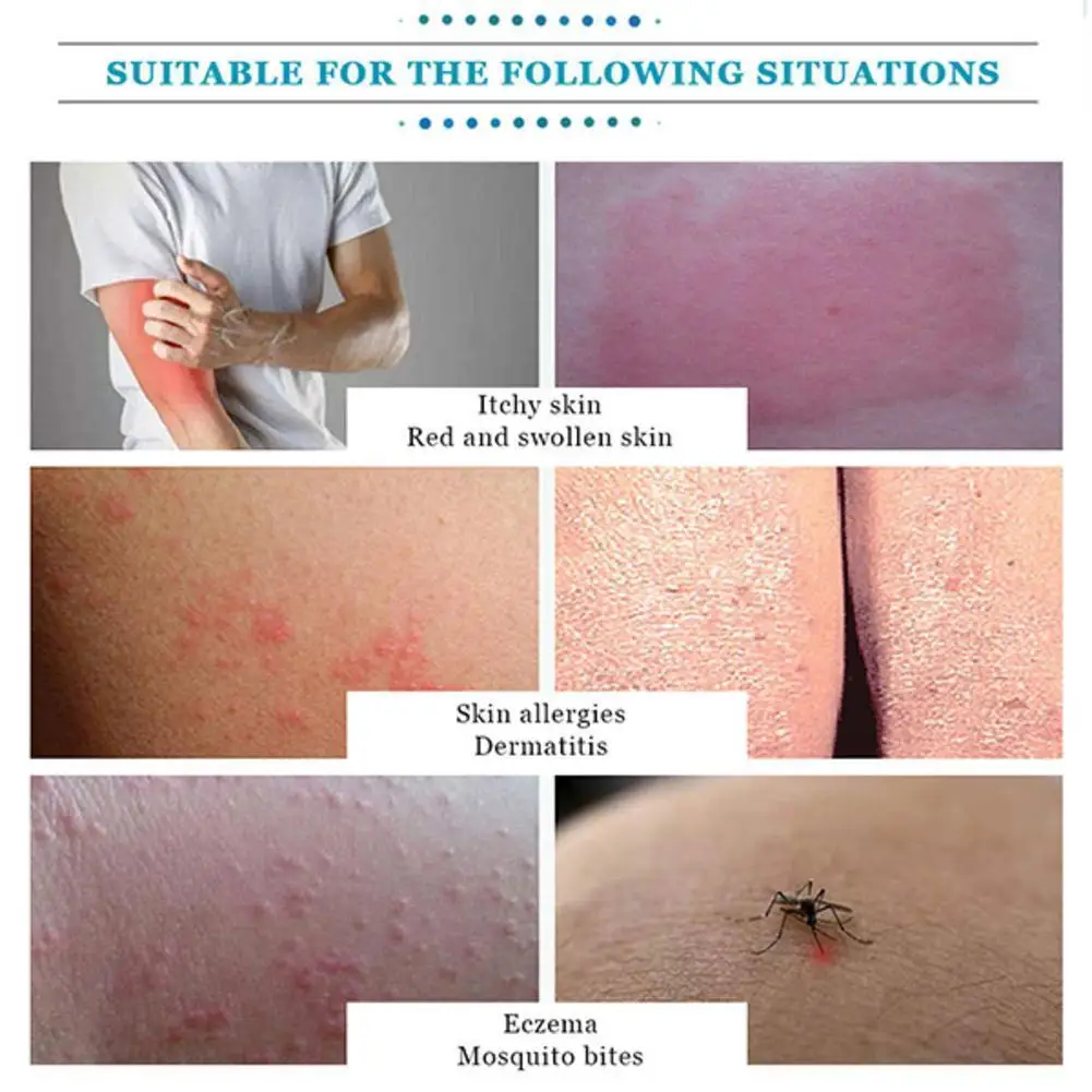 

20g Advanced Body Psoriasis Cream For Dermatitis and Eczema Pruritus Psoriasis Ointment Herbal Antibacterial Cream for eczema