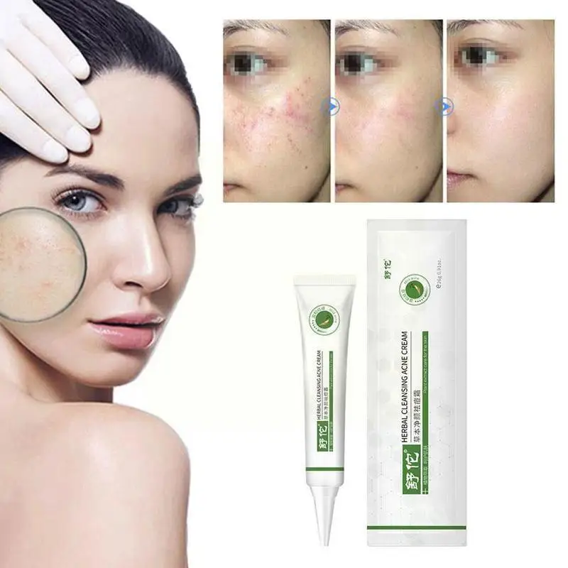 Угревой сыпи травяной крем для чистки ремонт акне косточки пор против уход