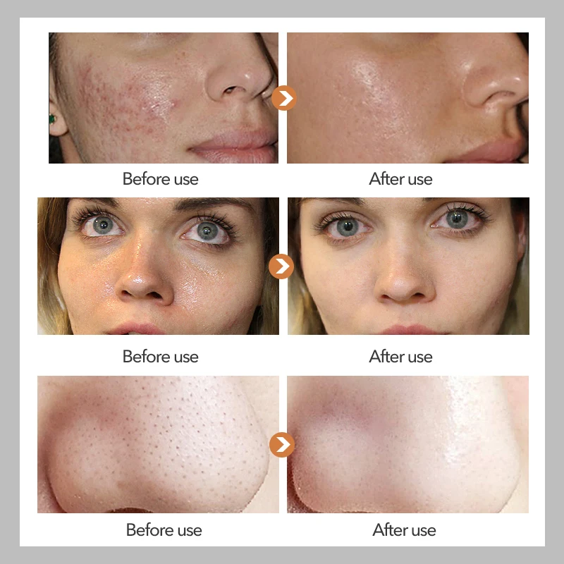 Daralis 100g шафран лечение акне мыло ручной работы глубокий Очищающая отбеливающая