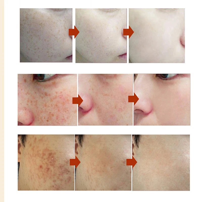 Отбеливающий крем Crema Blanqueadora Melasma для пигментации, удаления веснушек, удаления темных пятен для ухода за кожей лица, осветление