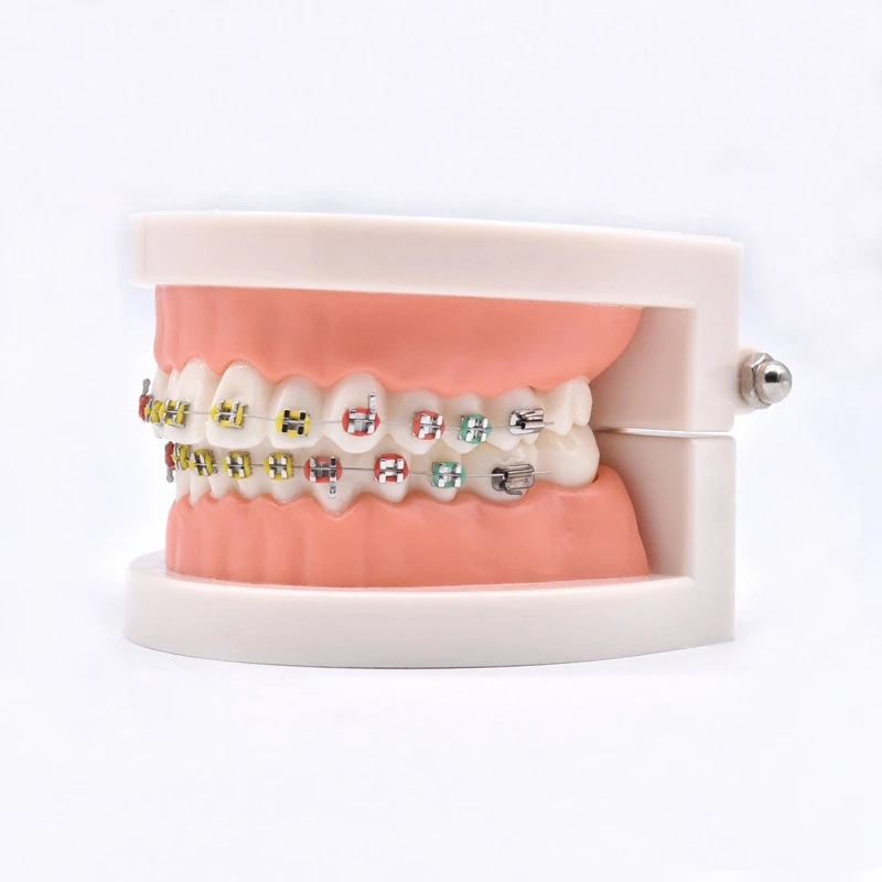 Ортодонтическая лечебная модель с ортодонтическим металлическим керамическим